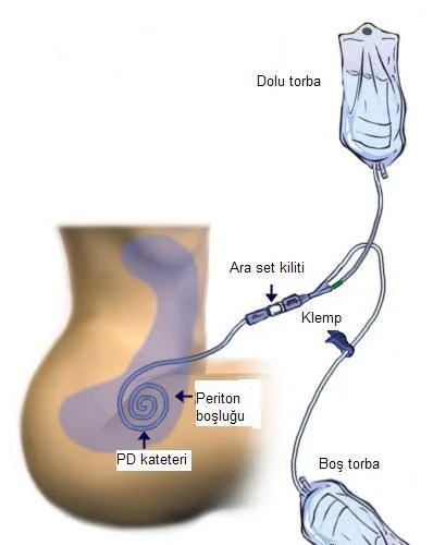 Şekil 2: Periton Diyalizi Tedavi Şeması